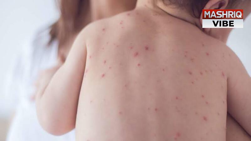 40 million children susceptible to the measles outbreak around the globe 
