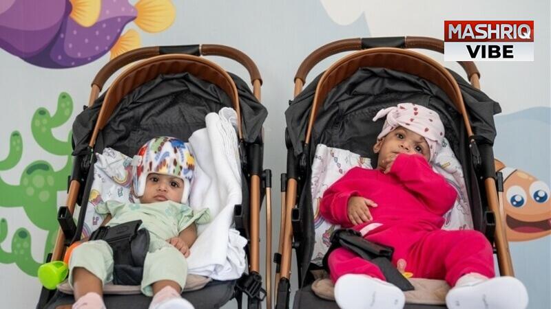 Turkish Doctors Successfully Separate Pakistani Conjoined Twins After Marathon Surgery